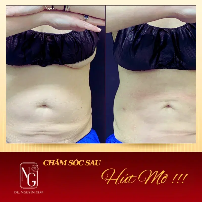 cham soc sau hut mo bung va nhung dieu can phai biet