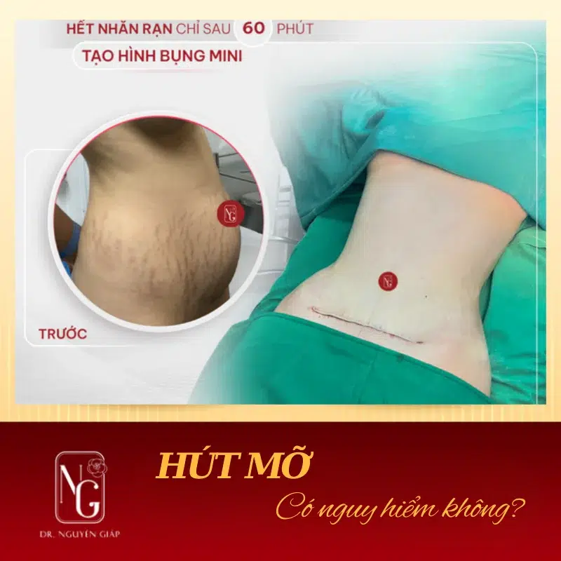 loi ich khi tham my hut mo