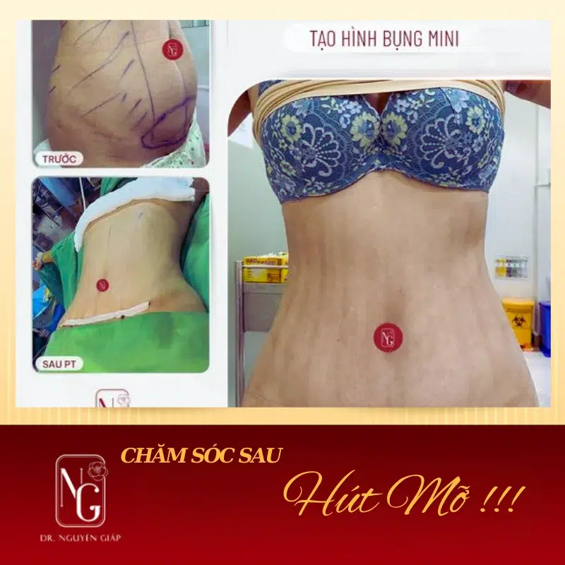 tai sao cham soc sau hut mo quan trong