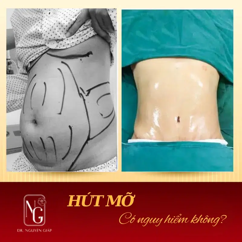 yeu to nao giup thuc hien tham my hut mo thanh cong