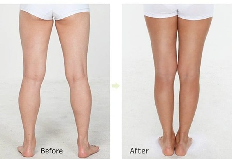 Hút mỡ bắp chân, đùi là gì?