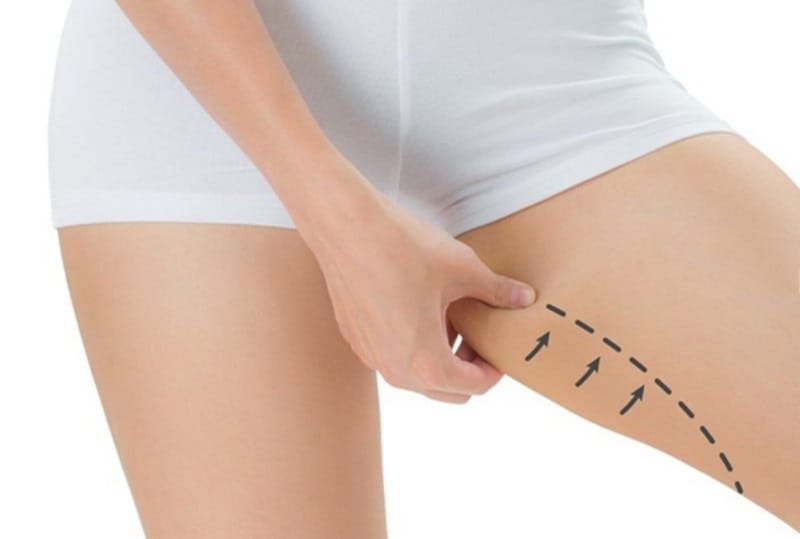 Ưu điểm hút mỡ đùi