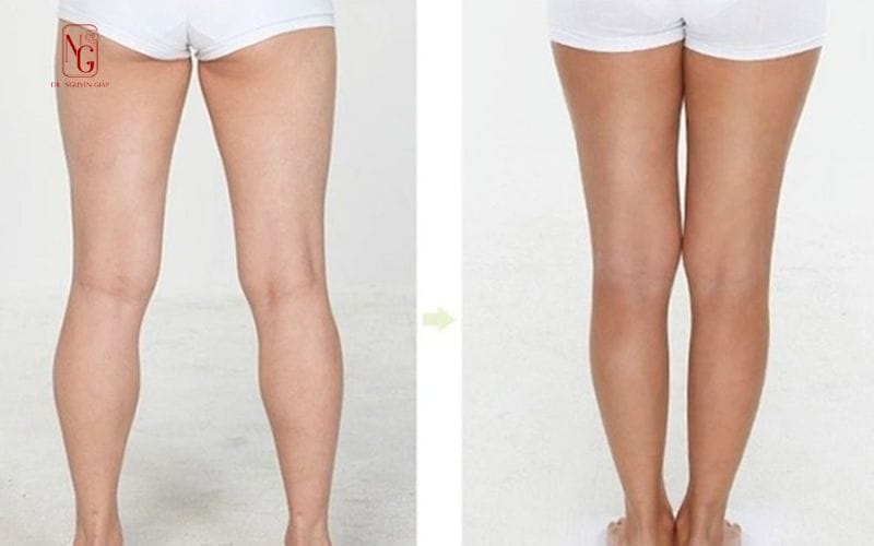 Hút Mỡ Bắp Đùi – Bí Quyết “Vàng” Cho Đôi Chân Quyến Rũ