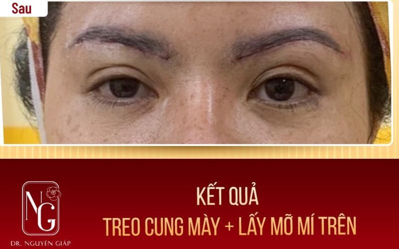 Lấy Mỡ Mí Mắt – Trẻ Hoá Đôi Mắt Không Tuổi Chỉ 30 Phút