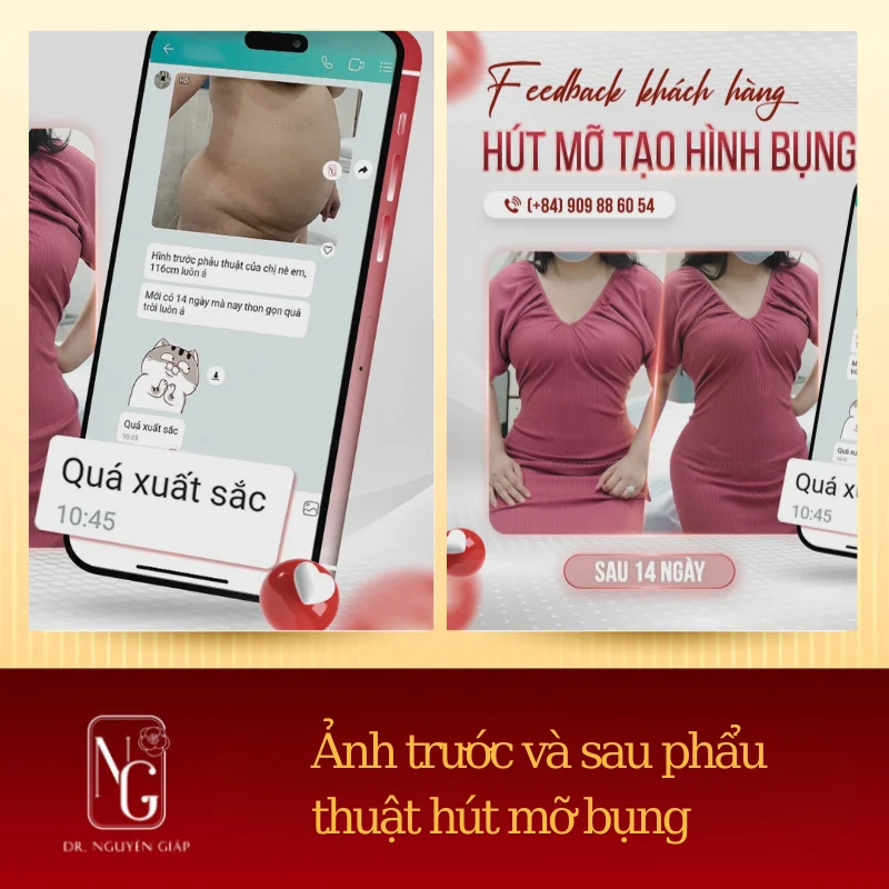 anh truoc va sau phau thuat tao hinh bung