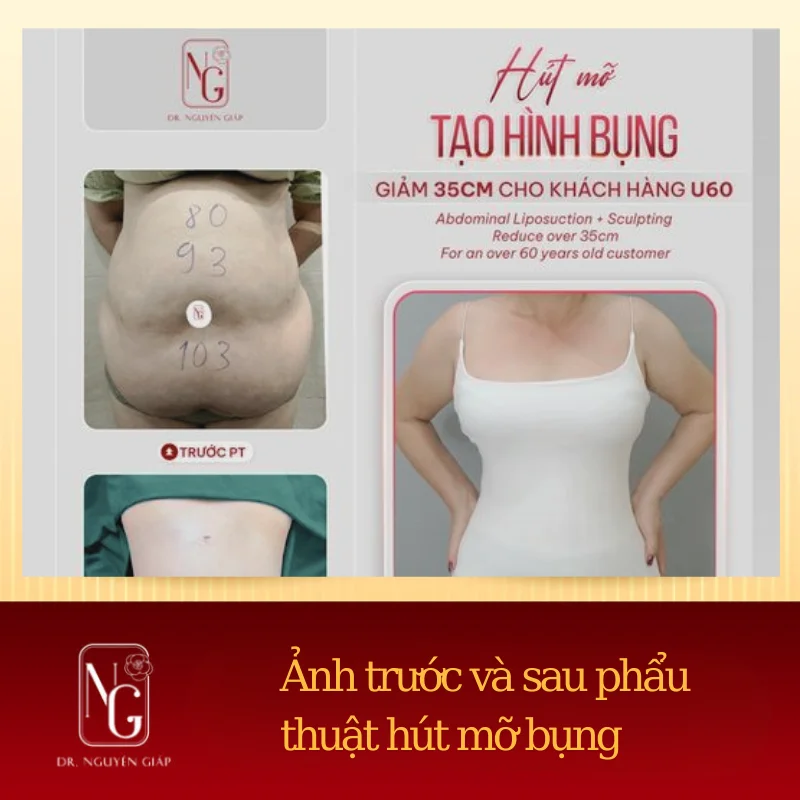 phau thuat tao hinh bung la loai bo da thua