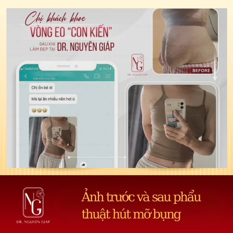 su khac biet khi ket hop hut mo bung