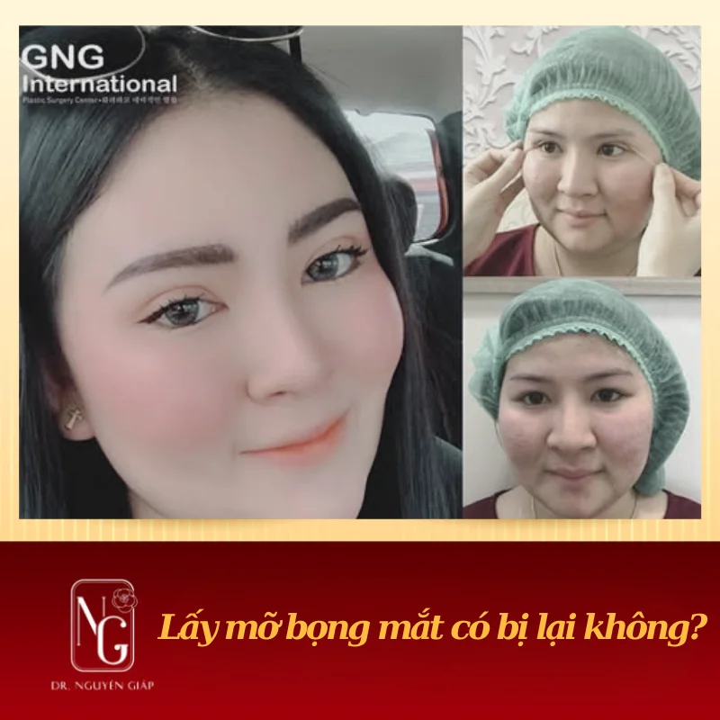 bong mat co the xuat hien lai khong