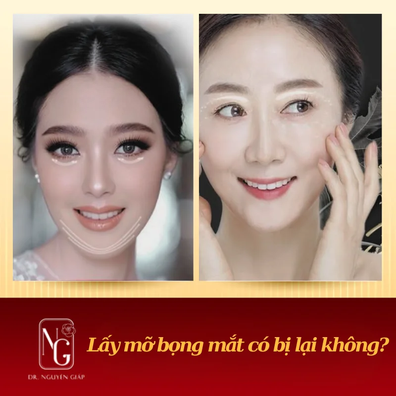 cham soc vung mat tai dr nguyen giap