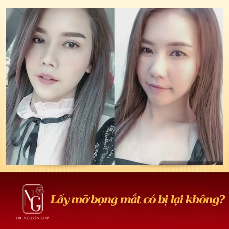 lấy mỡ bọng mí mắt có bị lại không