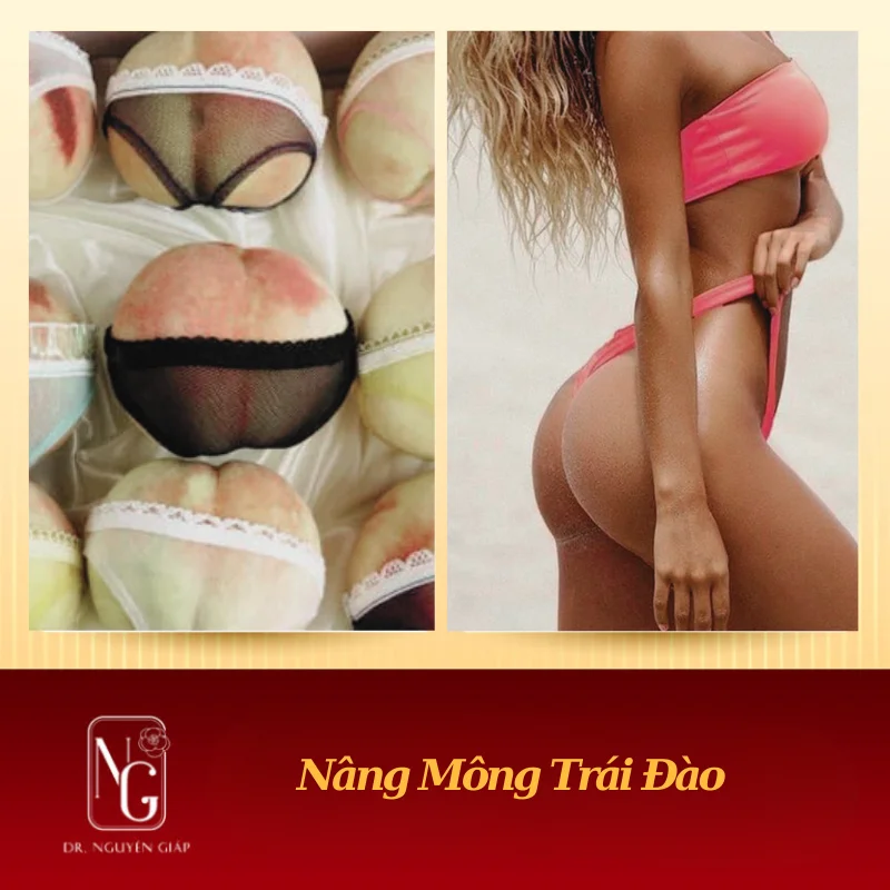 nâng mông trái đào quyến rũ bằng cấy mỡ tự thân