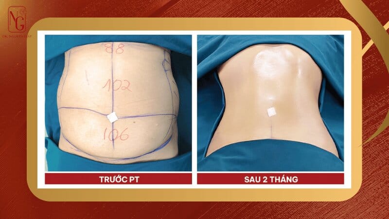 lam dep don tet bang phuong phap hut mo bung