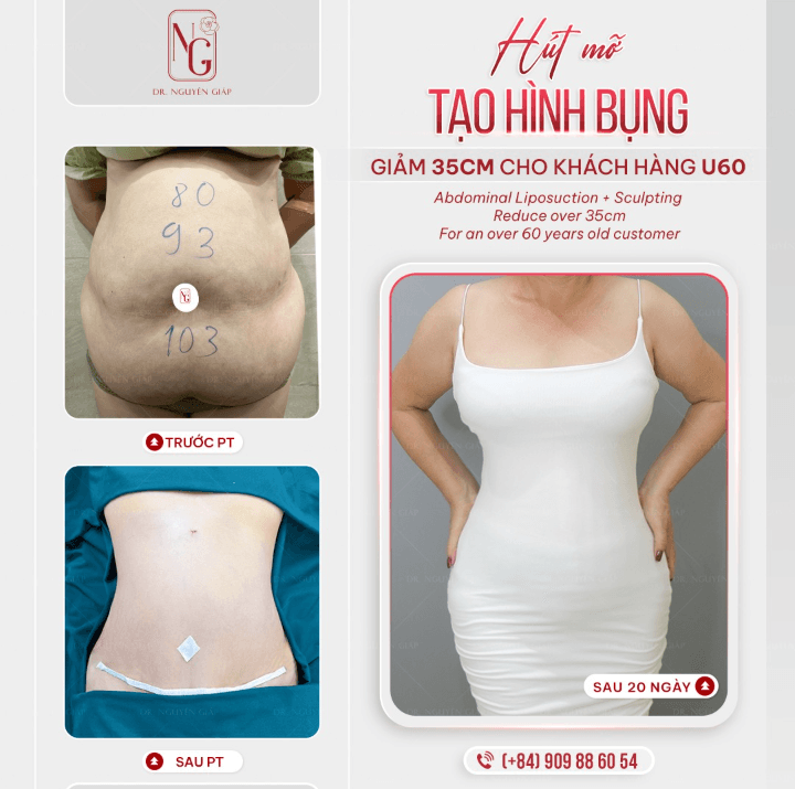 quy trinh thuc hien phau thuat tummy tuck