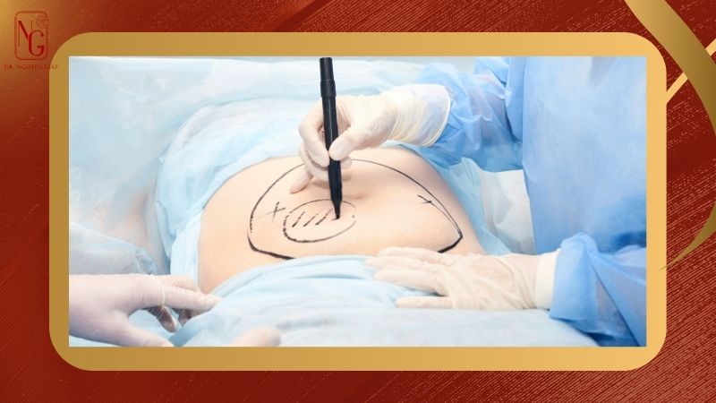 bien chung cay mo tu than va nhung dieu ban can biet truoc khi lam dep