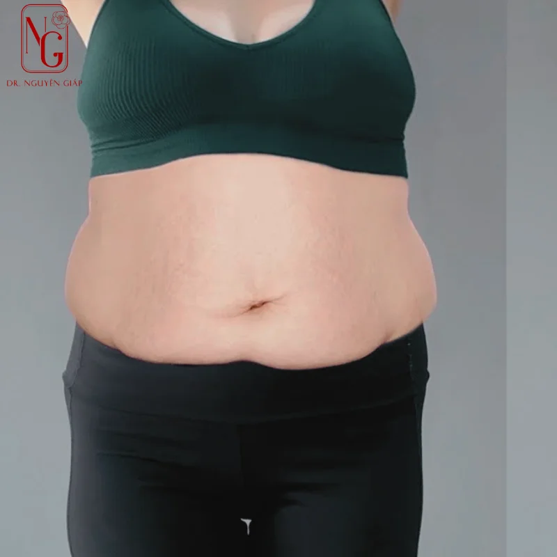 hut mo bung an toan tai benh vien tham my uy tin