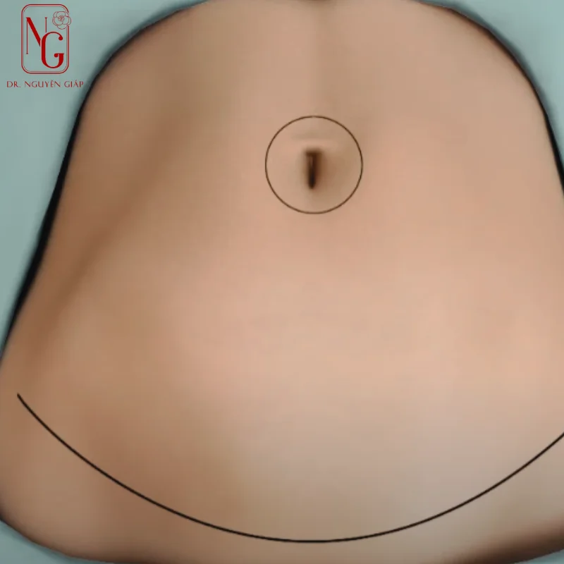 phuong phap tao hinh bung cho me sau sinh