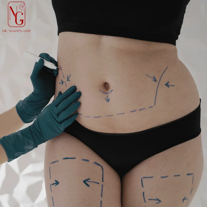 quy trinh thuc hien phau thuat tummy tuck