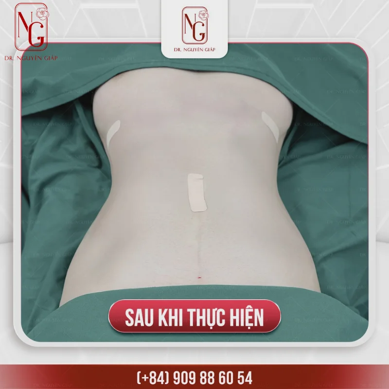 hinh anh truoc va sau khi tiem tan mo bung