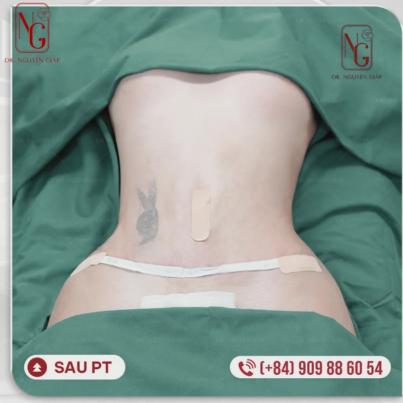 tiem tan mo bung giup giam mo nhanh chong