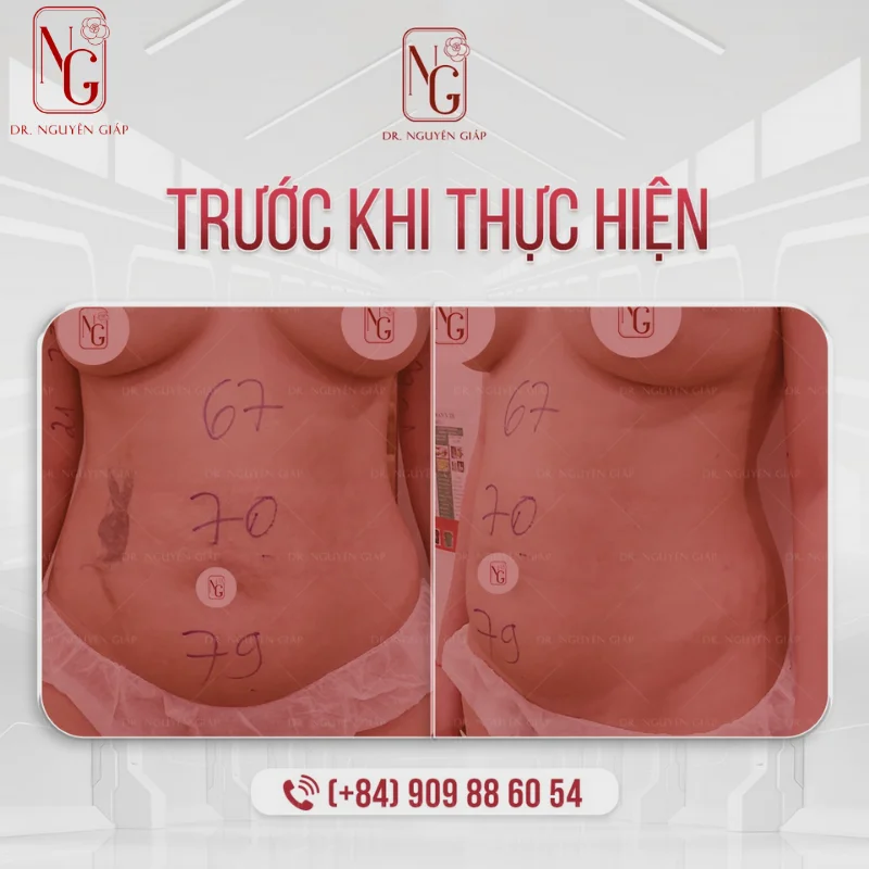 truoc khi thuc hien tiem mo bung