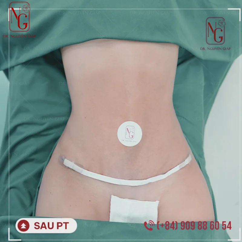 ung dung cong nghe ho tro giam mo bung