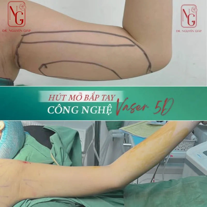 hinh anh bap tay thon gon