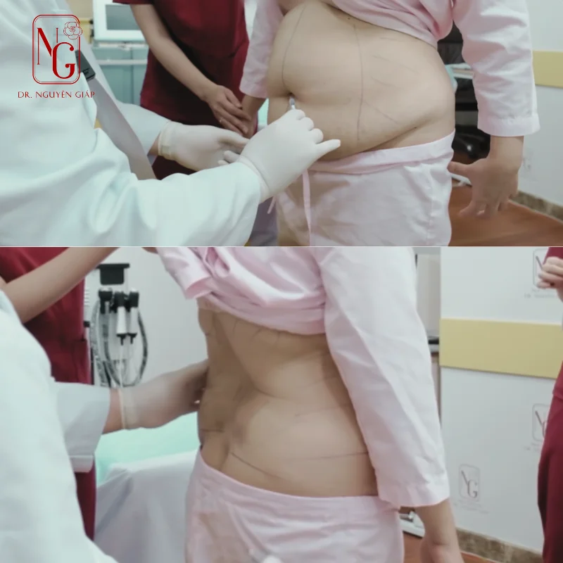 hinh anh truoc khi hut mo bung