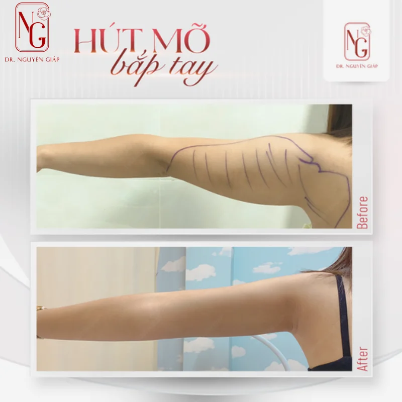 hut mo bap tay cho nu