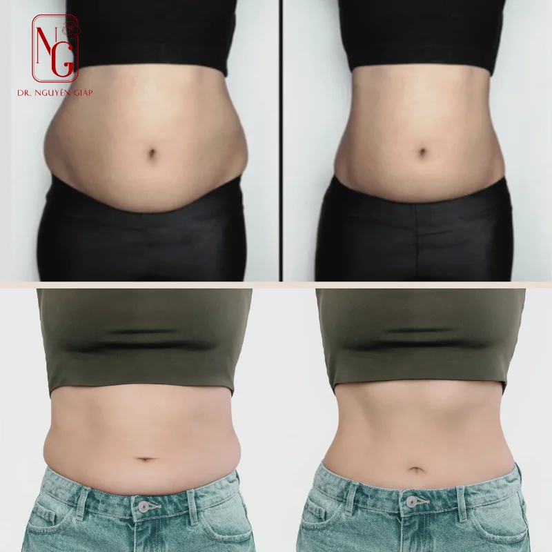 hut mo bung lipo ultrasound voi cong nghe hien dai