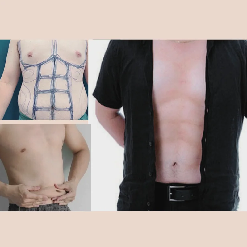 hut mo bung tao hinh 6 mui