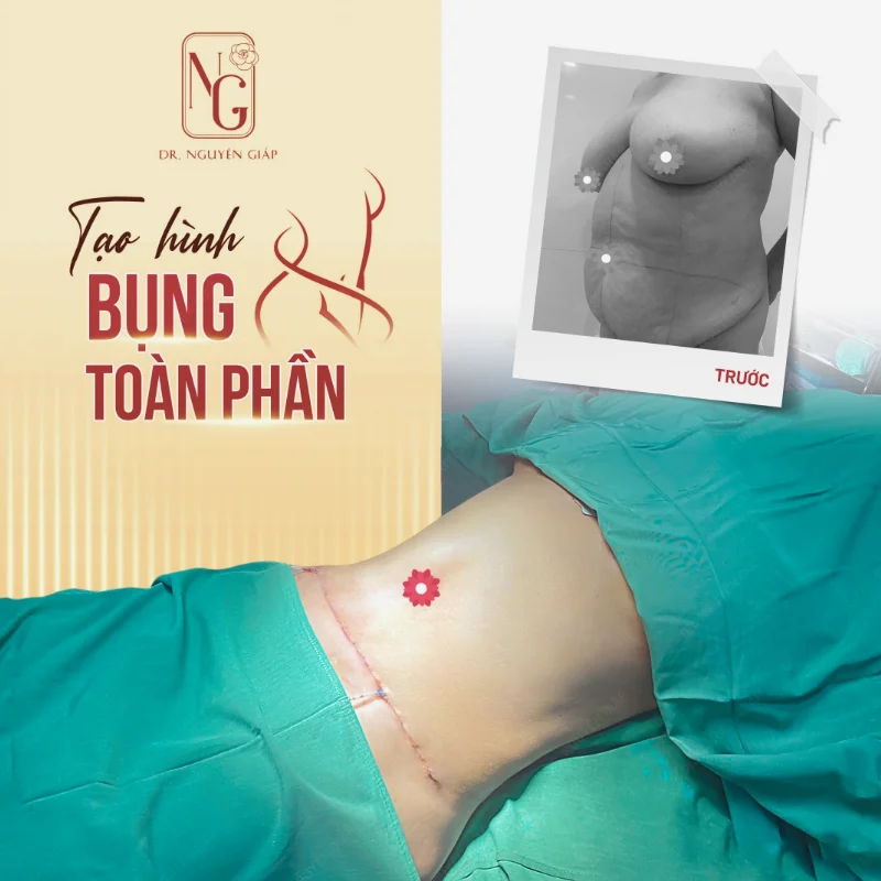 ket qua sau khi hut mo bung duoi