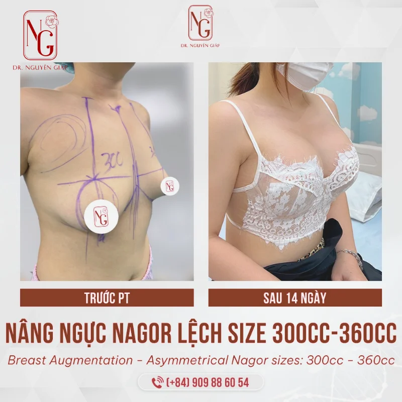 nang nguc giup can doi vong 1 boc lua