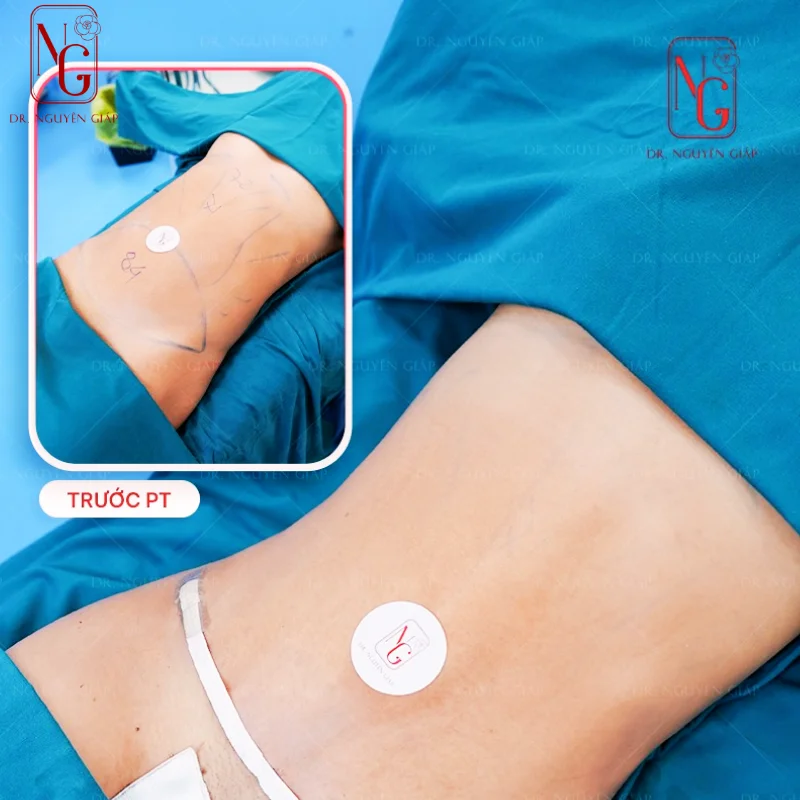 phau thuat hut mo bung de co vong eo dep