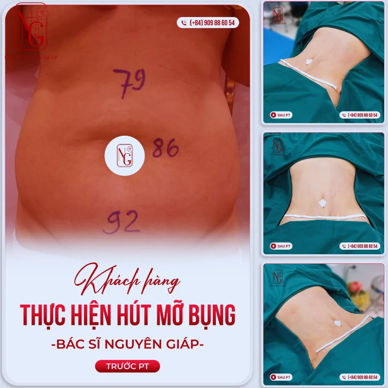 phuong phap hut mo bung tao hinh vong eo thon gon