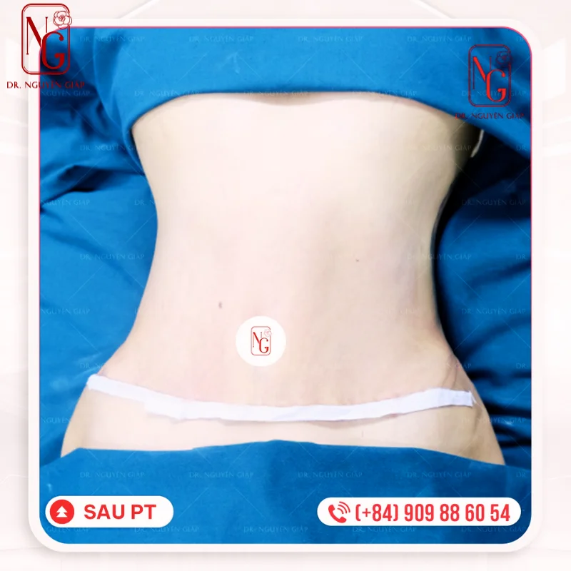 sau khi thuc hien hut mo bung sau sinh hieu qua