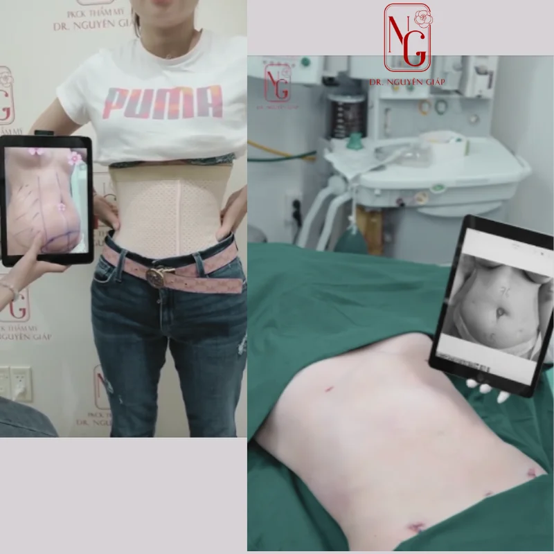 su dung cong nghe hut mo bung