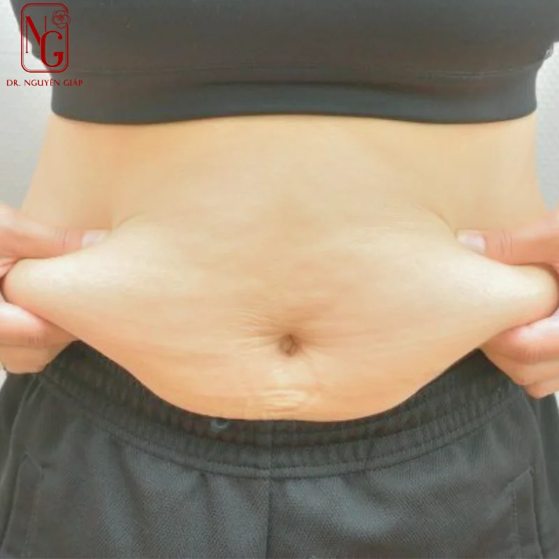 tinh trang mo du thua