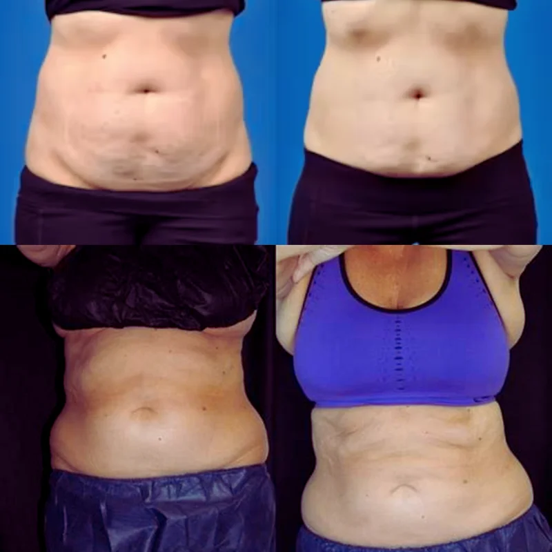 tinh trang phu ne sau hut mo