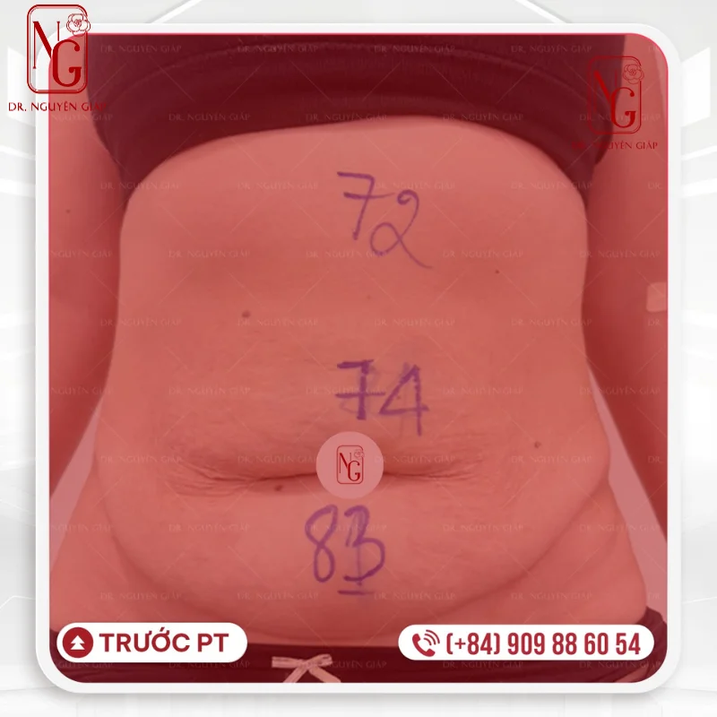 truoc khi hut mo bung