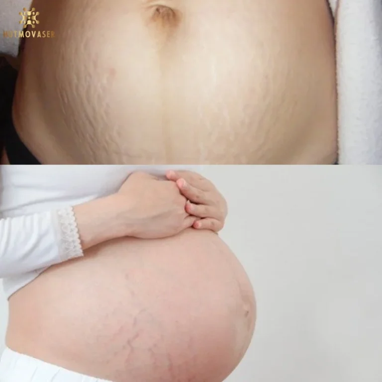 bung phu nu sau sinh