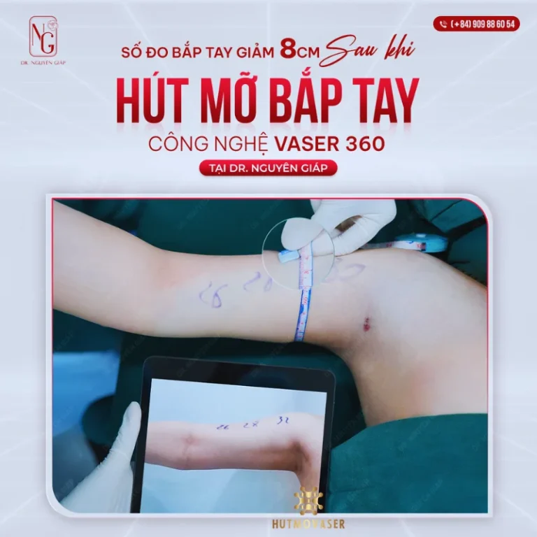 cong nghe hut mo bap tay