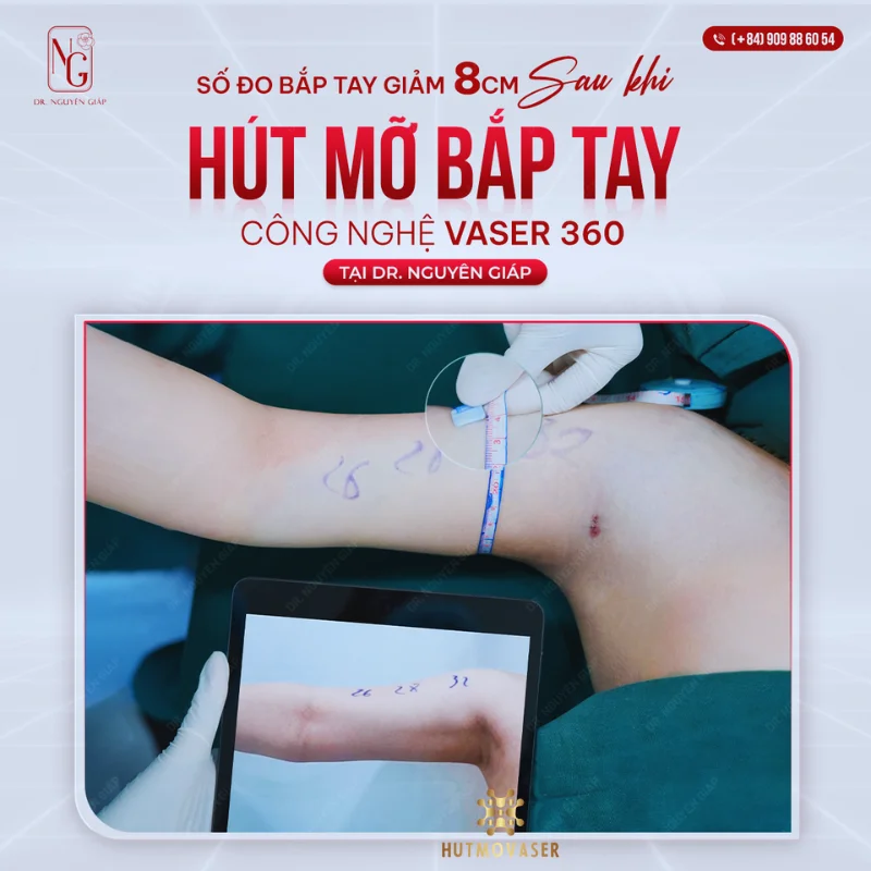 cong nghe hut mo bap tay