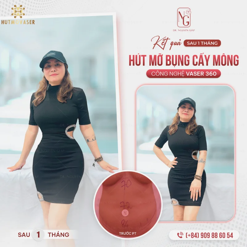 dang dep nho phau thuat hut mo