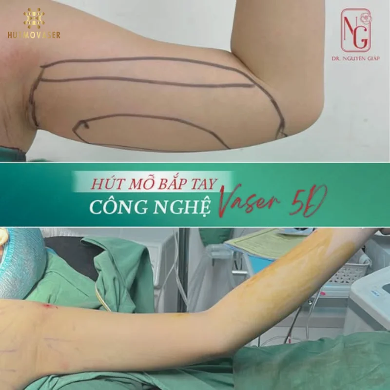 hut mo bap tay nhu the nao