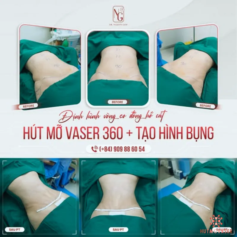 hut mo bung cho benh nhan