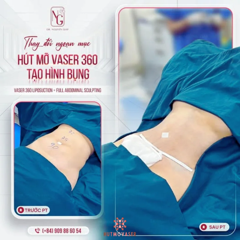 hut mo bung tao vong eo quyen ru