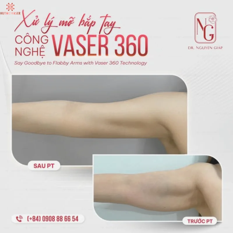 sau khi hut mo bap tay