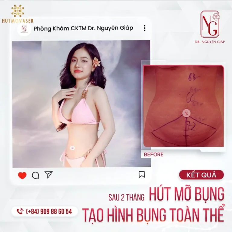 sau phau thuat tao hinh bung dep