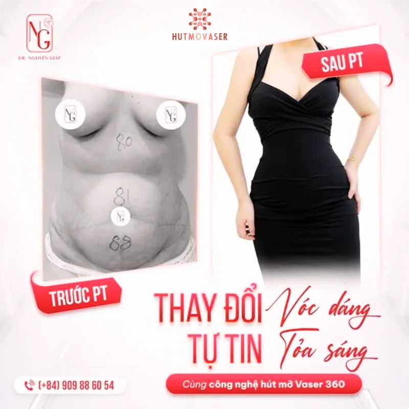 so sanh hinh anh truoc va sau hut mo vung bung