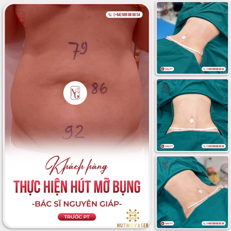 thuc hien tao hinh bung